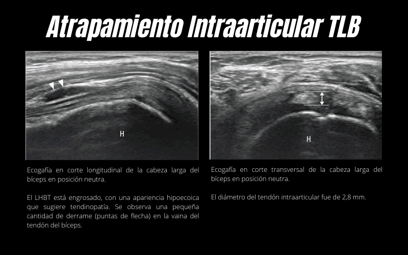 Atrapamiento Intraarticulacion Tendón Largo Bíceps Ecografía.png